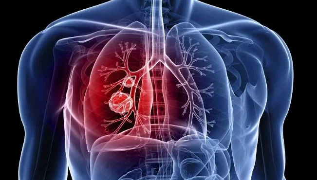 Tuberculose